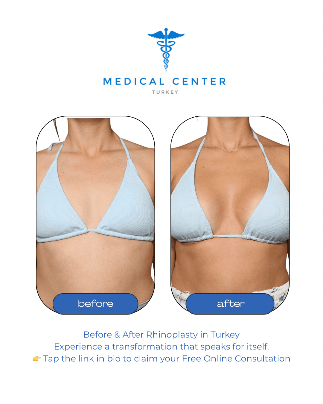 Breast augmentation before and after result 1 — Medical Center Turkey patient