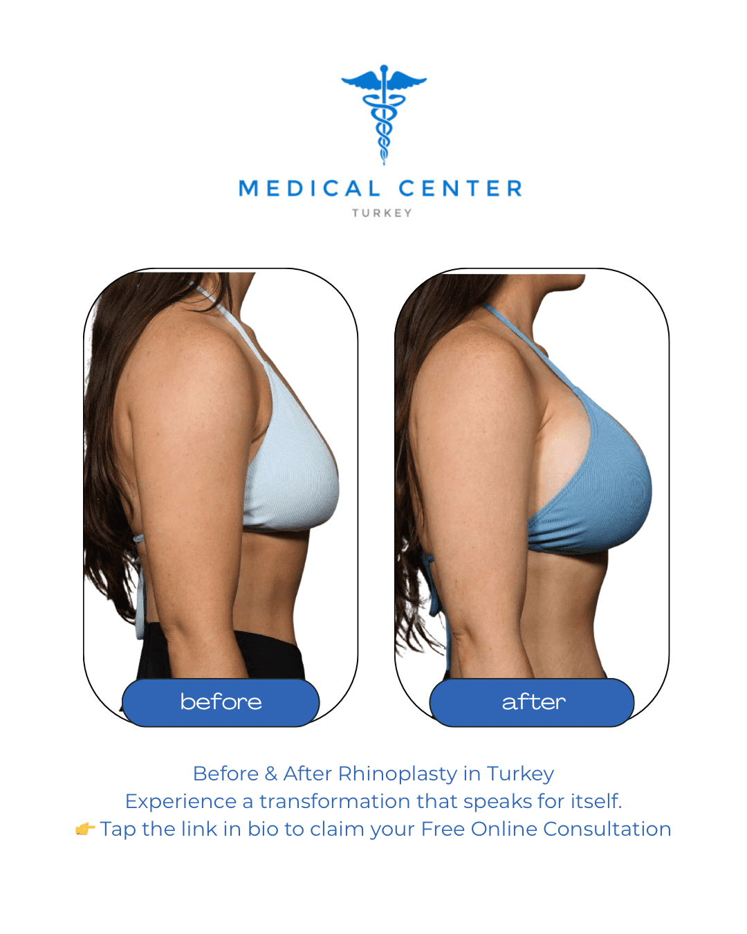 Breast augmentation before and after result 2 — Medical Center Turkey patient