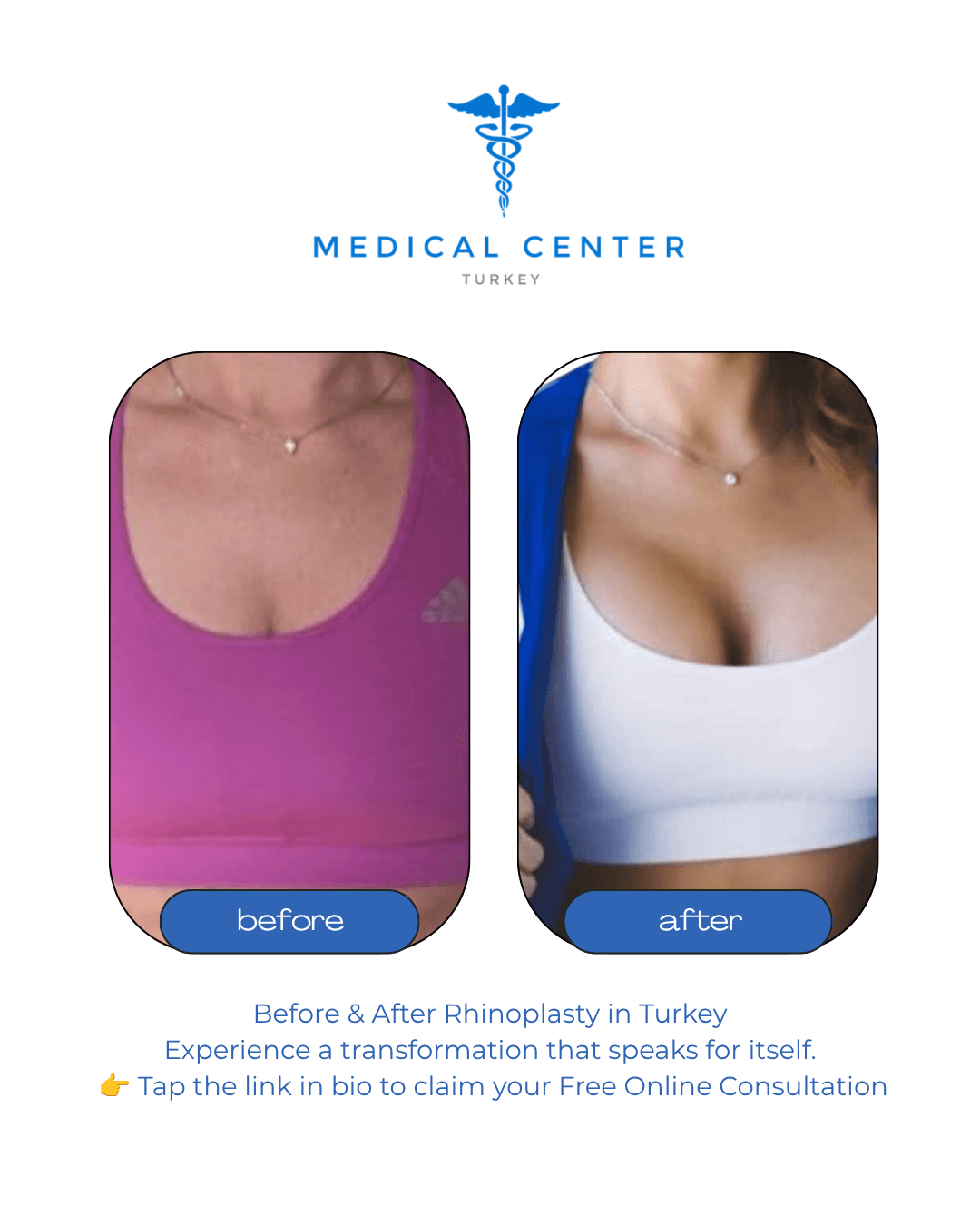 Breast augmentation before and after result 3 — Medical Center Turkey patient