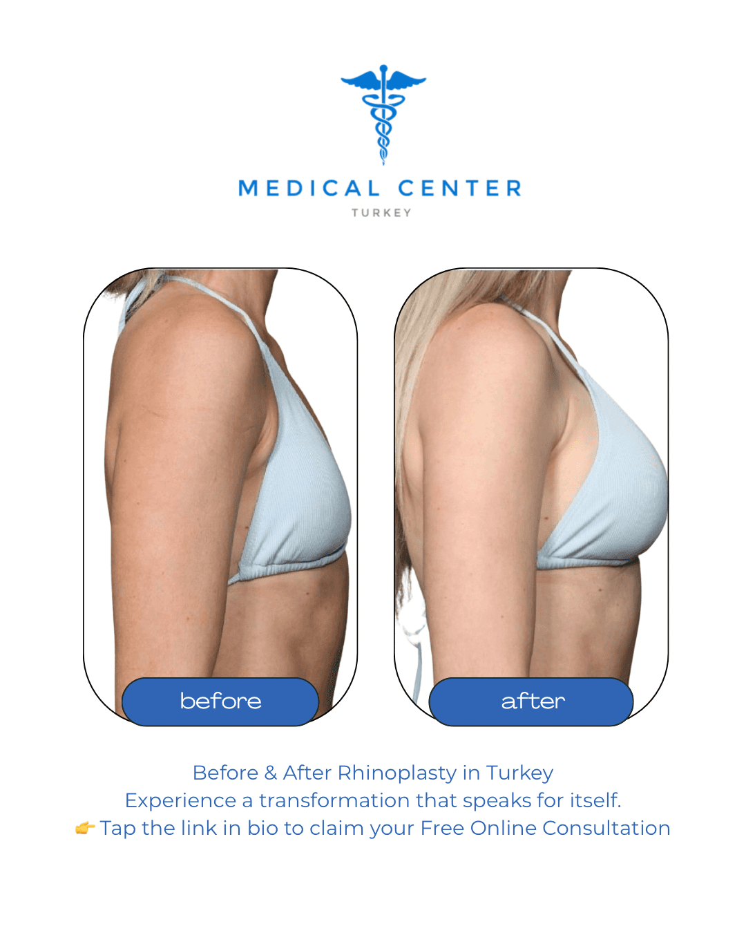 Breast augmentation before and after result 4 — Medical Center Turkey patient