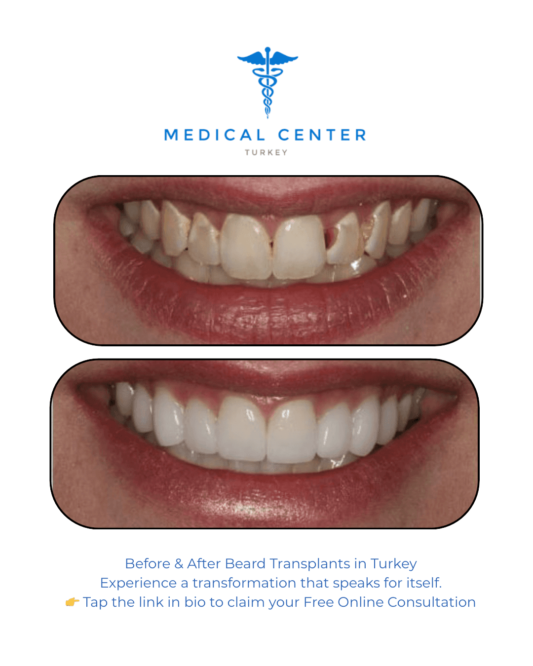 Dental implant before and after result 1 — Medical Center Turkey patient