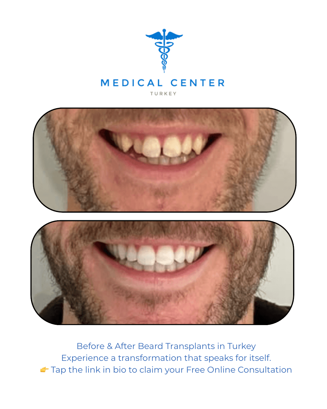 Dental implant before and after result 2 — Medical Center Turkey patient