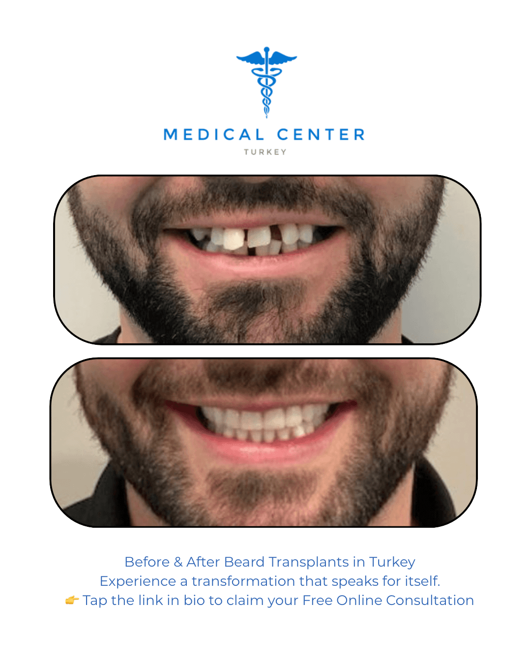 Dental implant before and after result 3 — Medical Center Turkey patient