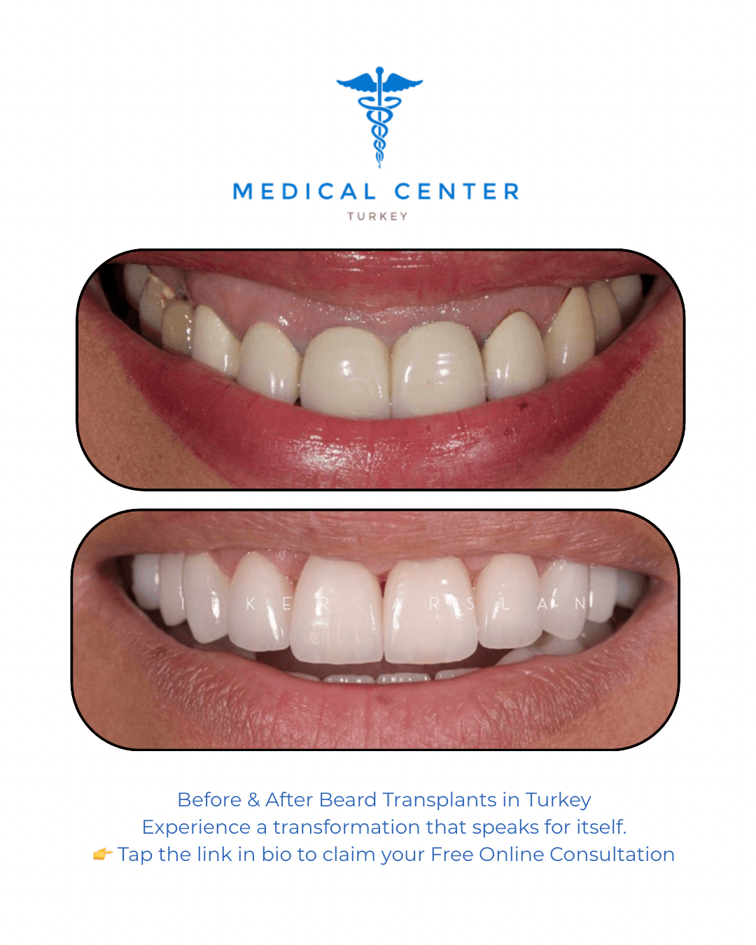 Dental implant before and after result 4 — Medical Center Turkey patient