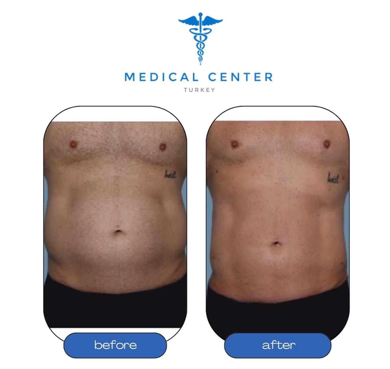 Liposuction before and after result 1 — Medical Center Turkey patient
