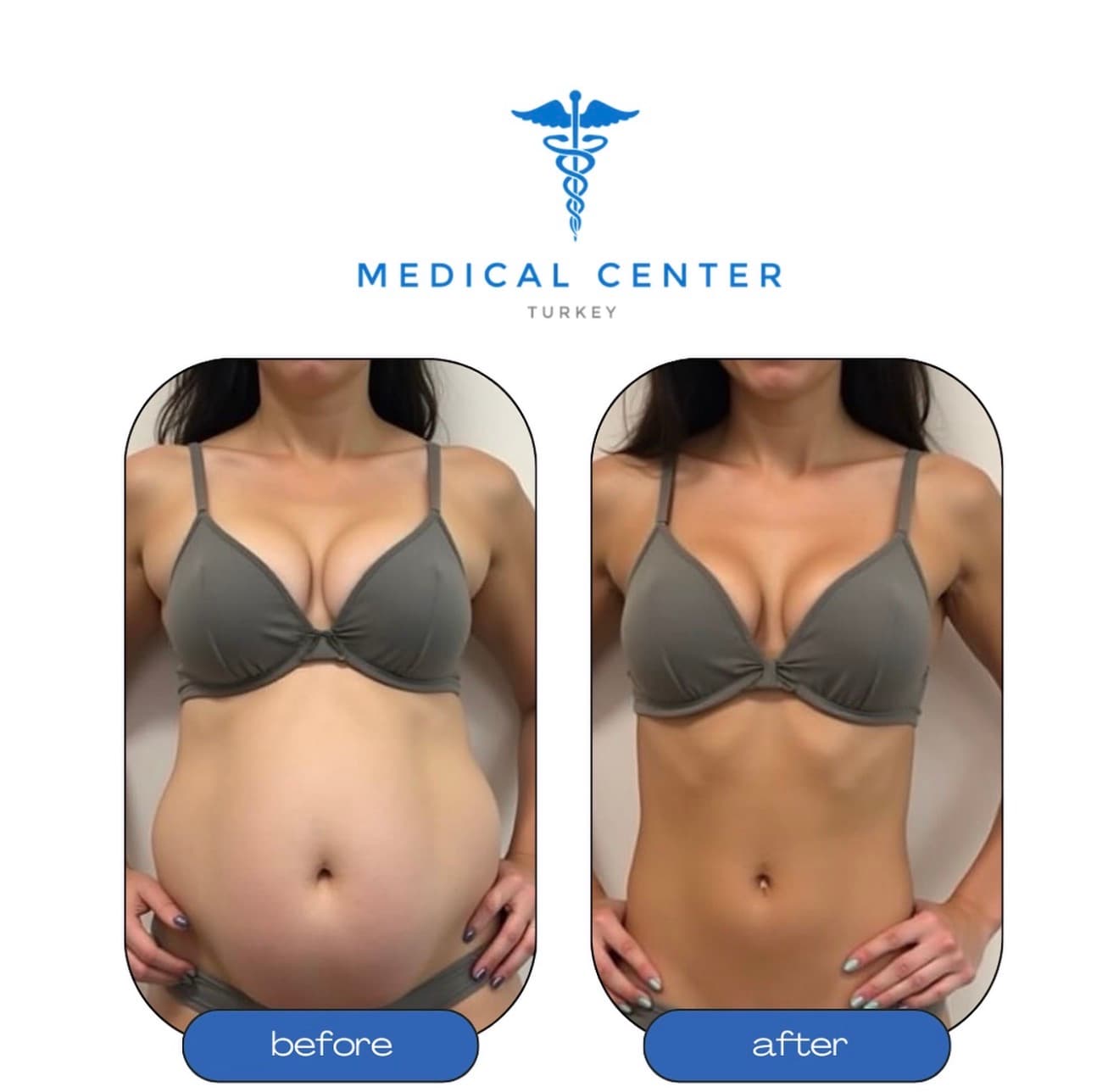 Liposuction before and after result 2 — Medical Center Turkey patient