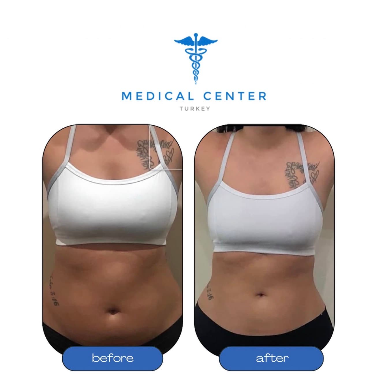 Liposuction before and after result 3 — Medical Center Turkey patient
