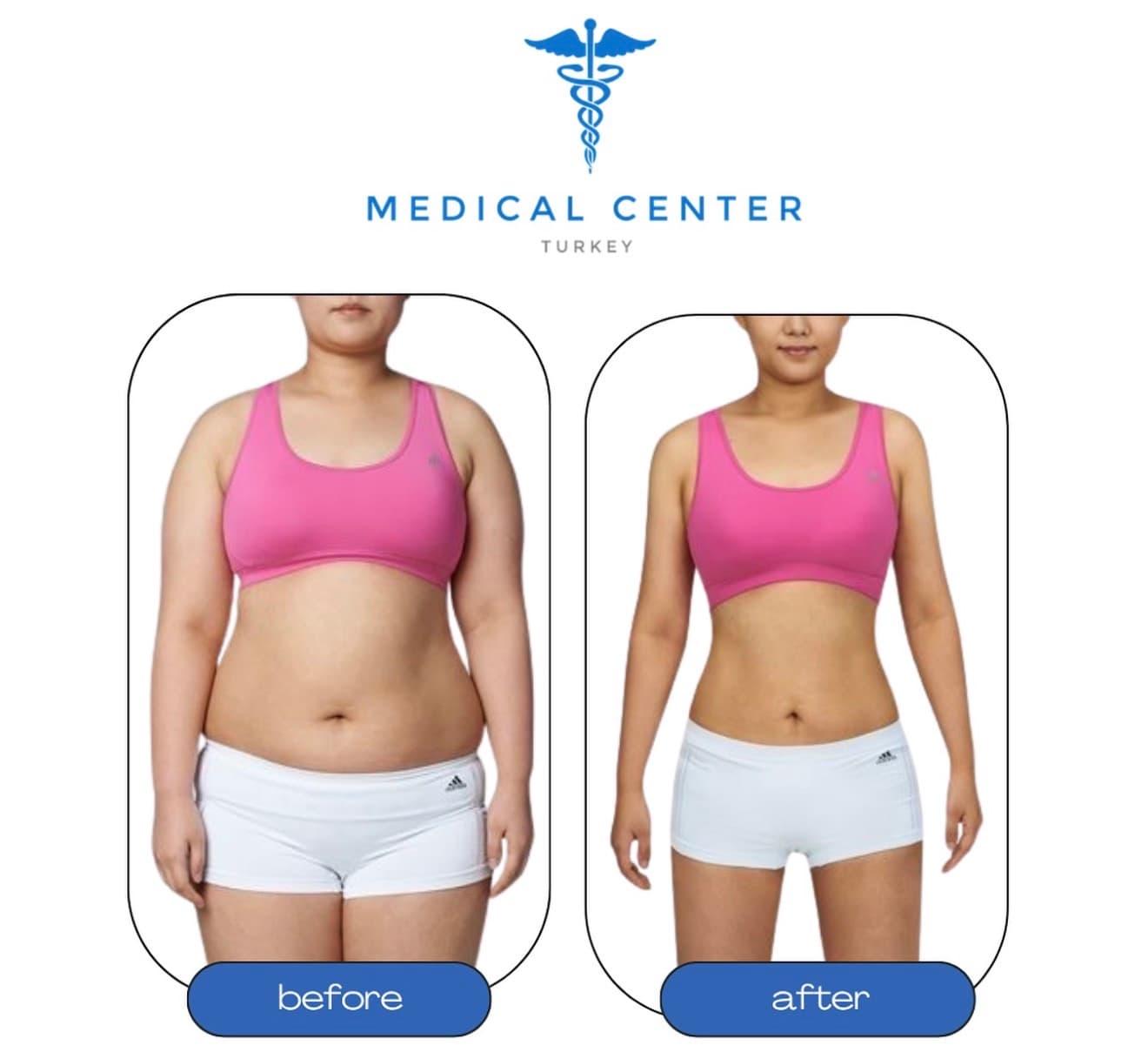 Liposuction before and after result 4 — Medical Center Turkey patient
