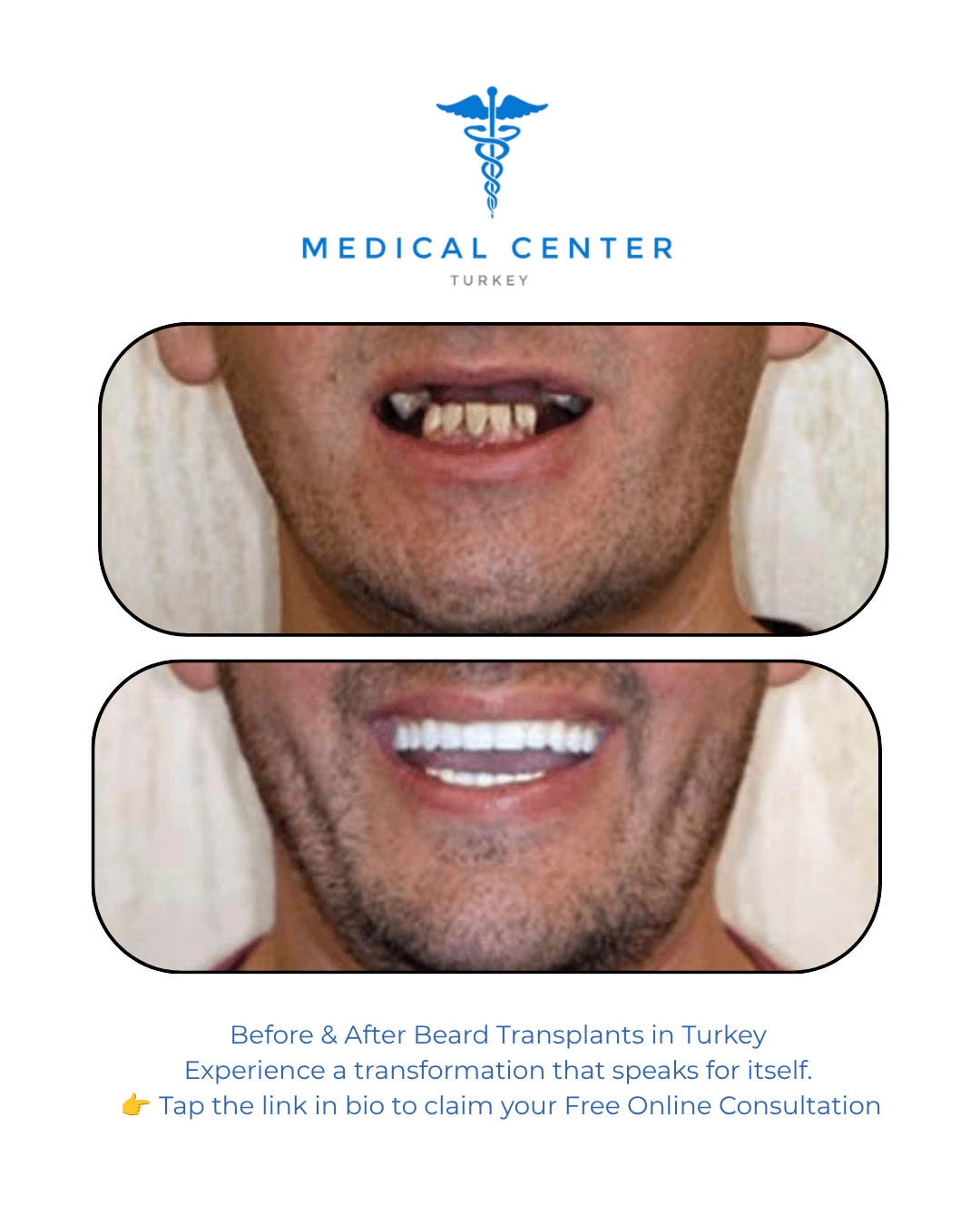 All-on-4 dental implant before and after result 1 — Medical Center Turkey patient