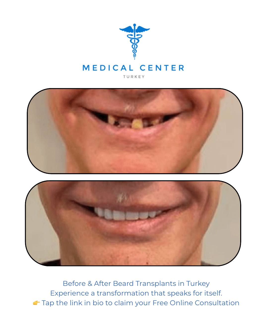 All-on-4 dental implant before and after result 2 — Medical Center Turkey patient