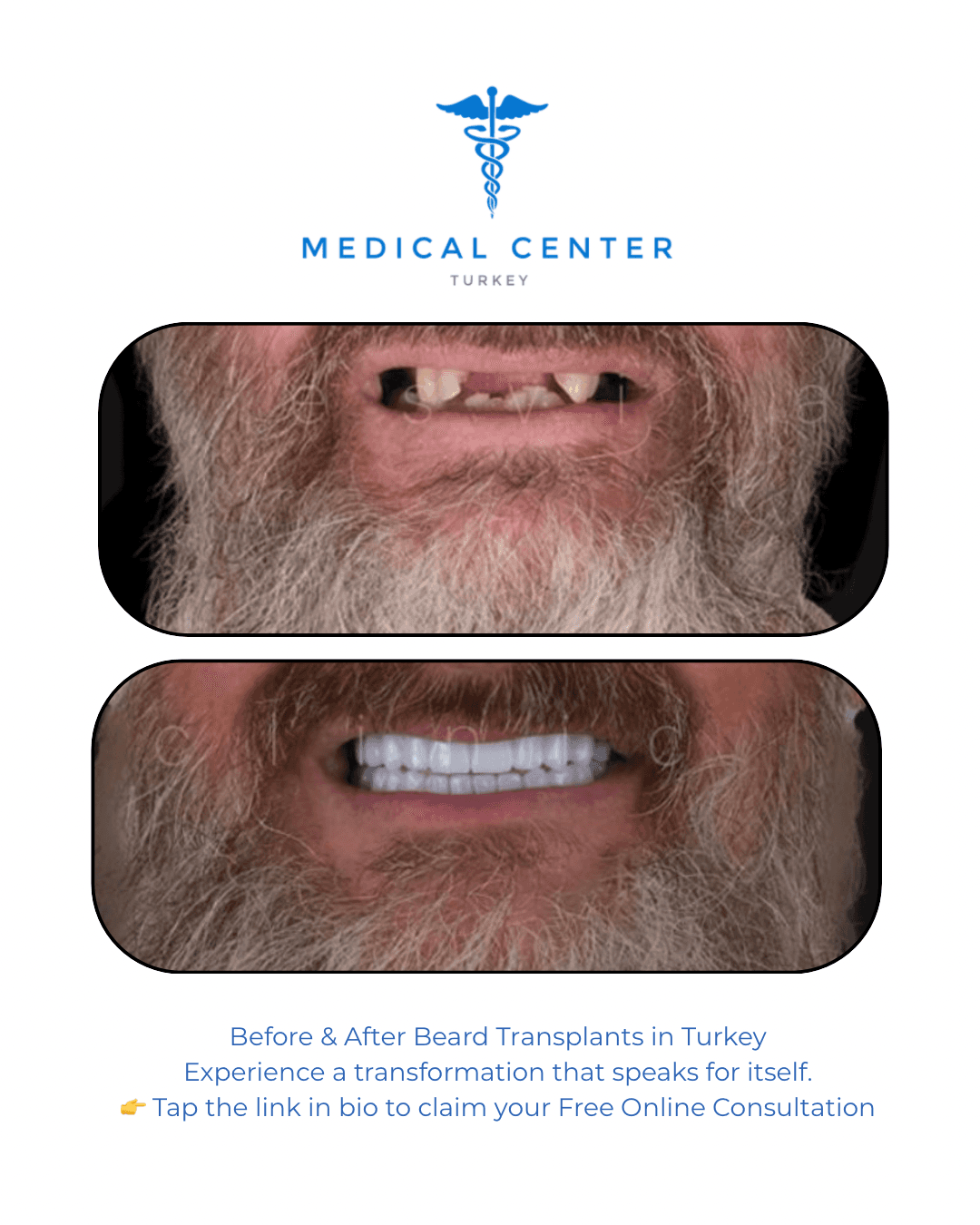 All-on-4 dental implant before and after result 3 — Medical Center Turkey patient