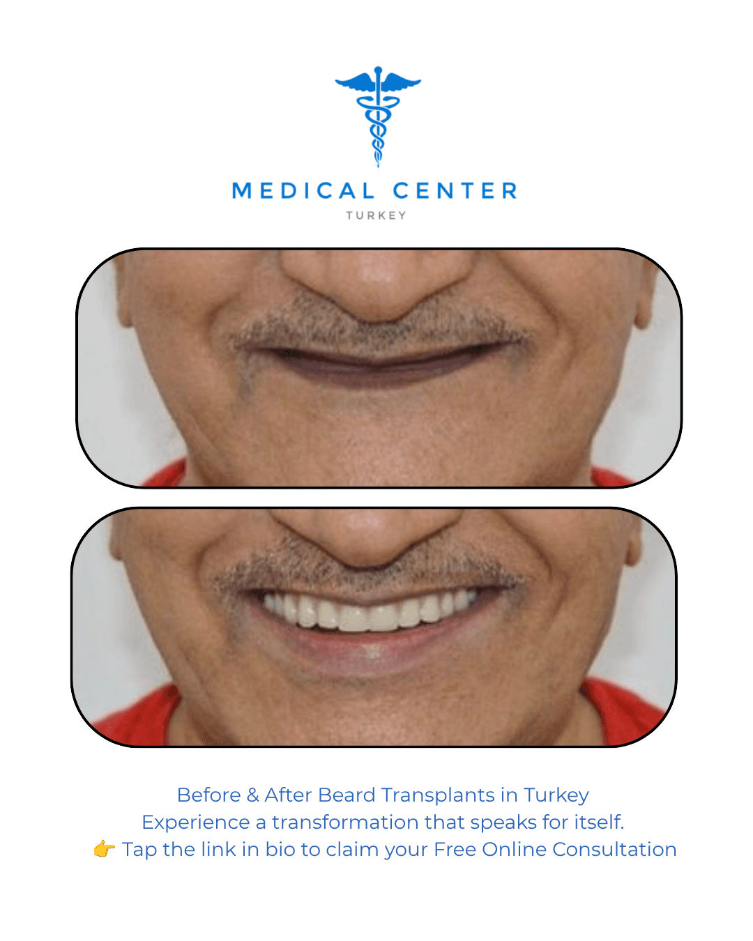 All-on-4 dental implant before and after result 4 — Medical Center Turkey patient