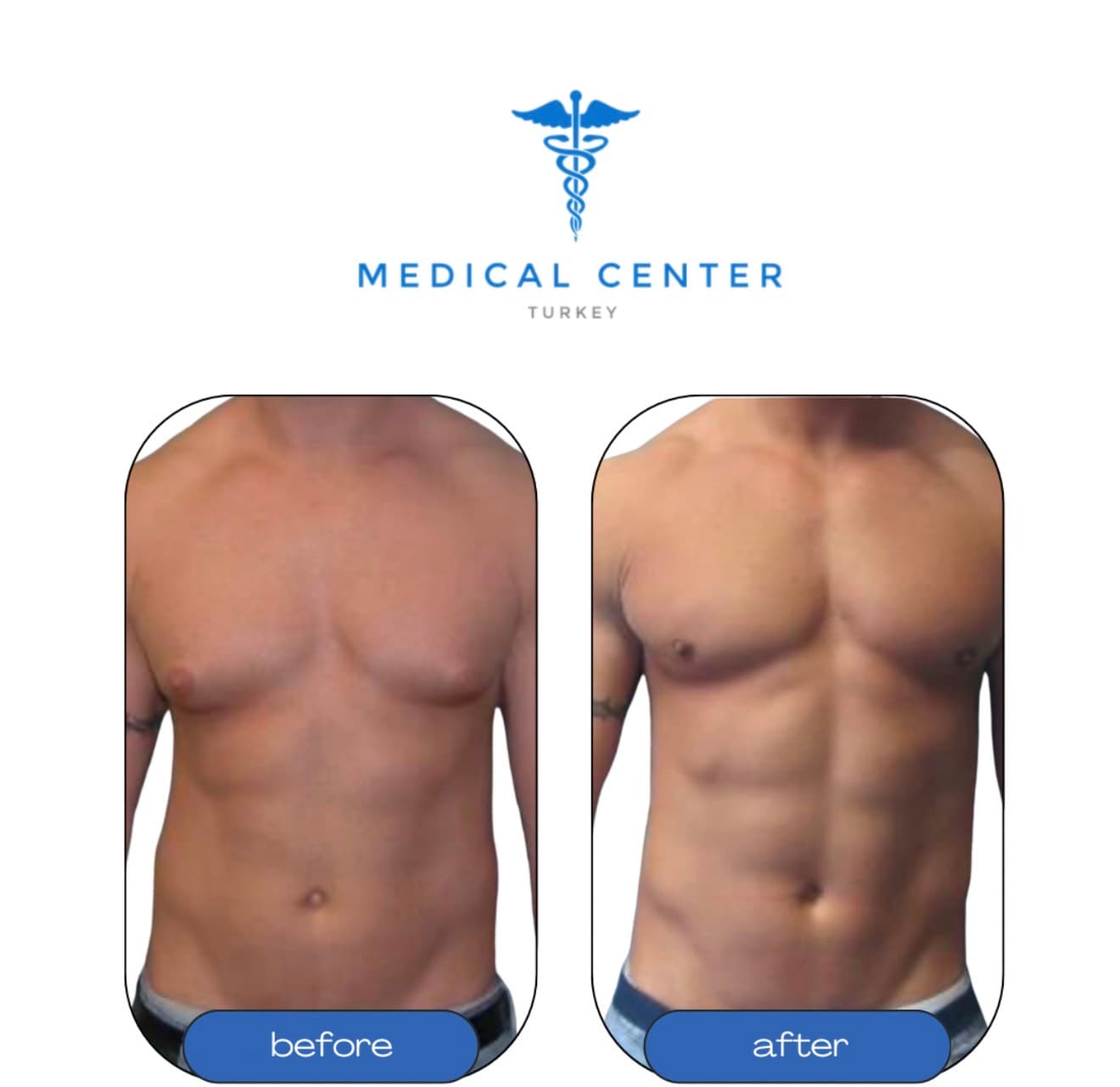 Gynecomastia before and after result 1 — Medical Center Turkey patient