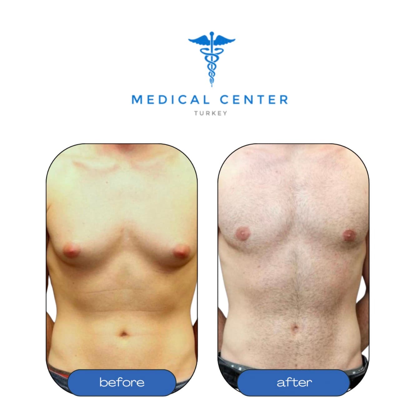 Gynecomastia before and after result 2 — Medical Center Turkey patient