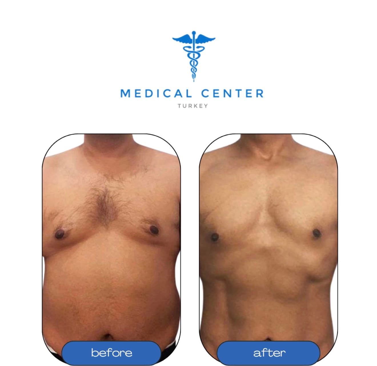 Gynecomastia before and after result 3 — Medical Center Turkey patient