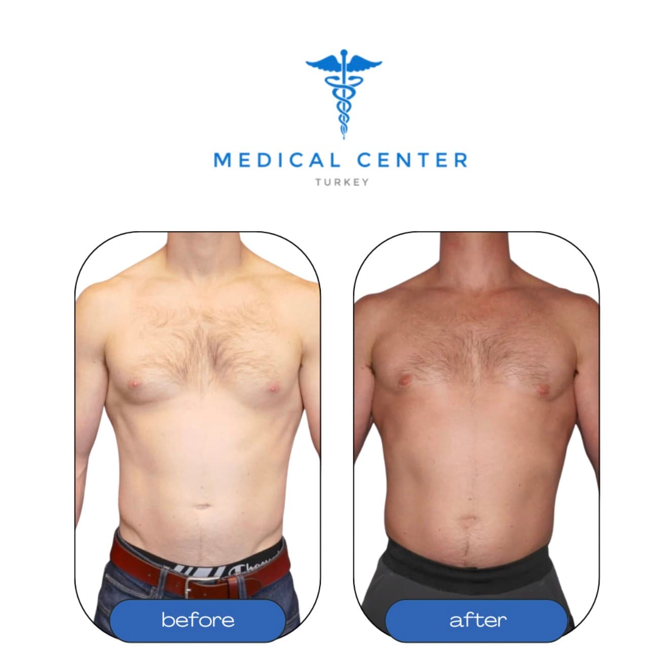 Gynecomastia before and after result 4 — Medical Center Turkey patient
