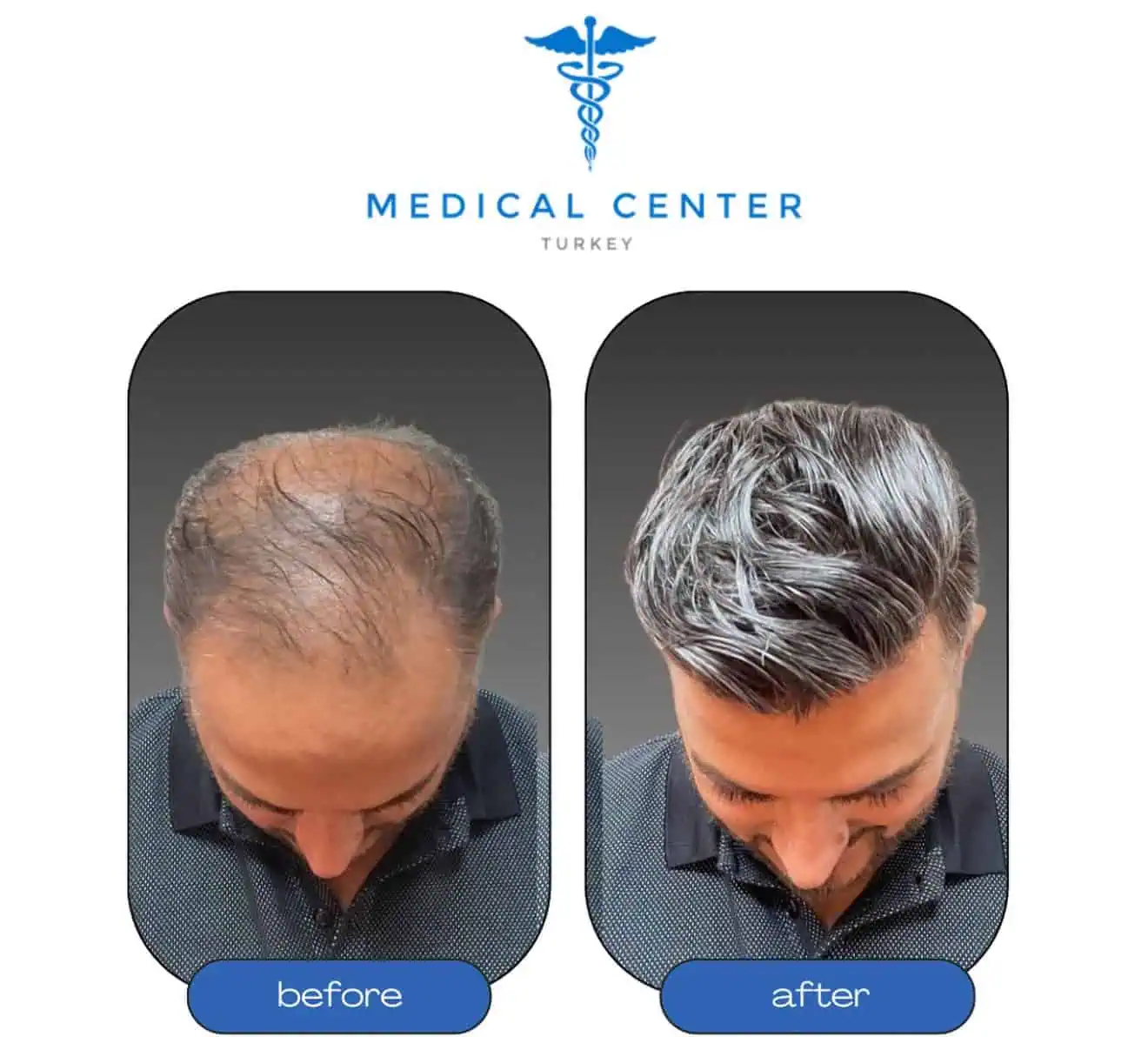 Hair transplant before and after result 1