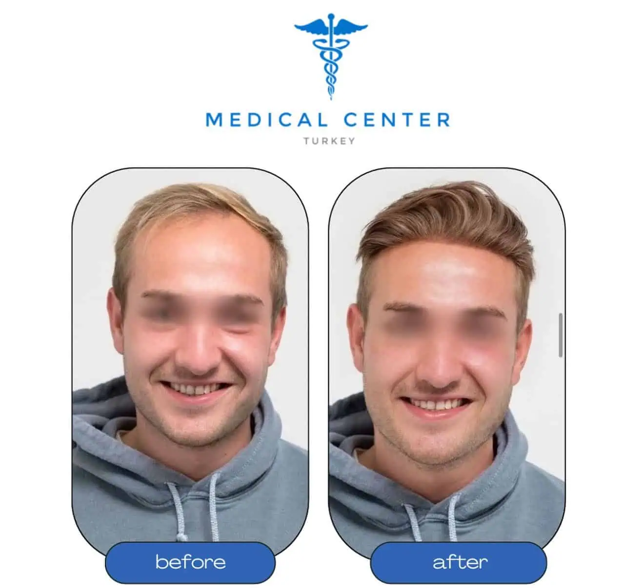 Hair transplant before and after result 2