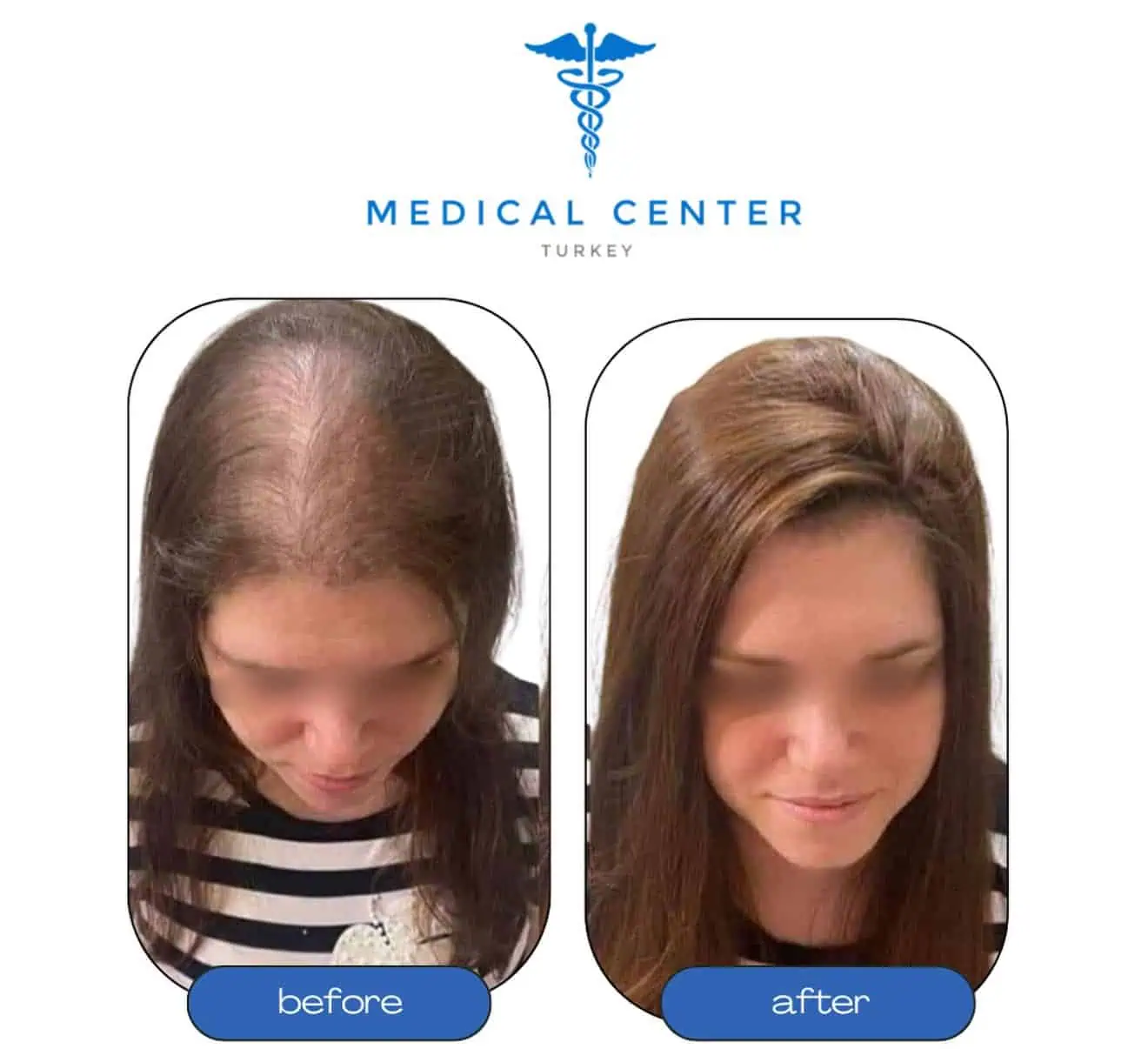 Hair transplant before and after result 3