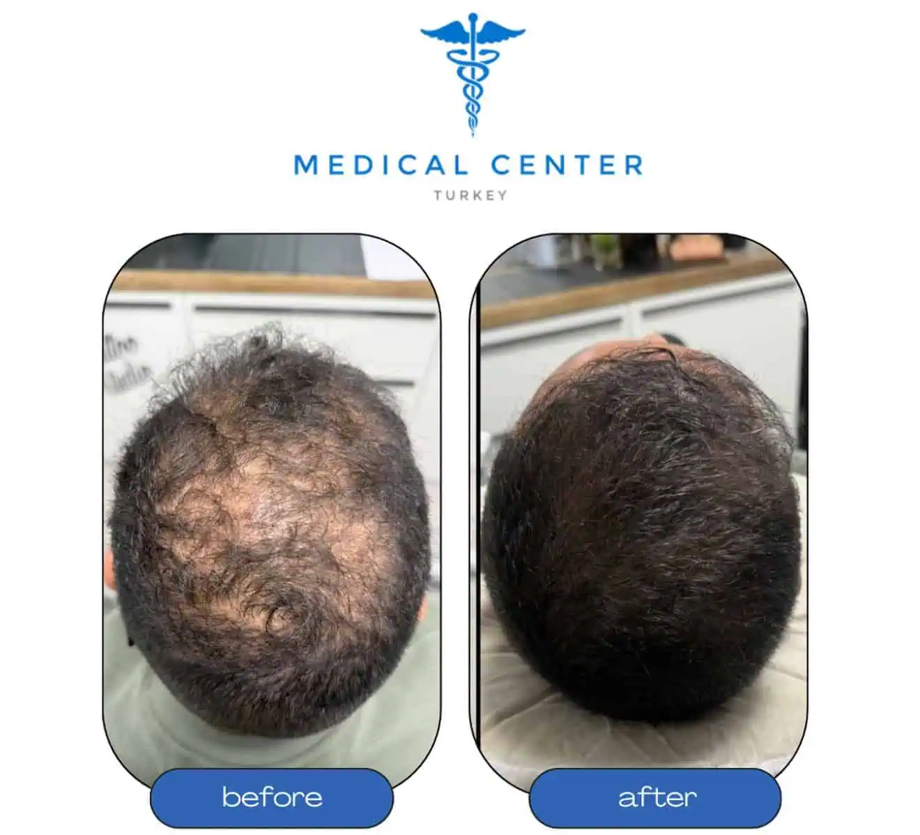 Hair transplant before and after result 4
