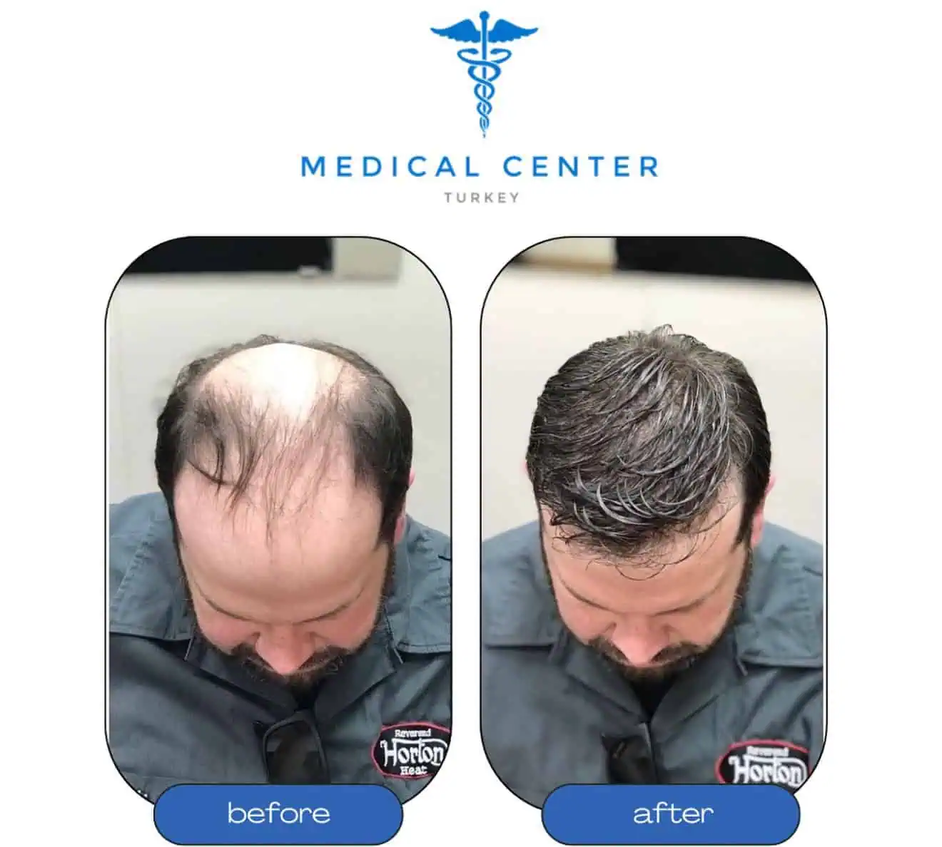 Hair transplant before and after result 5