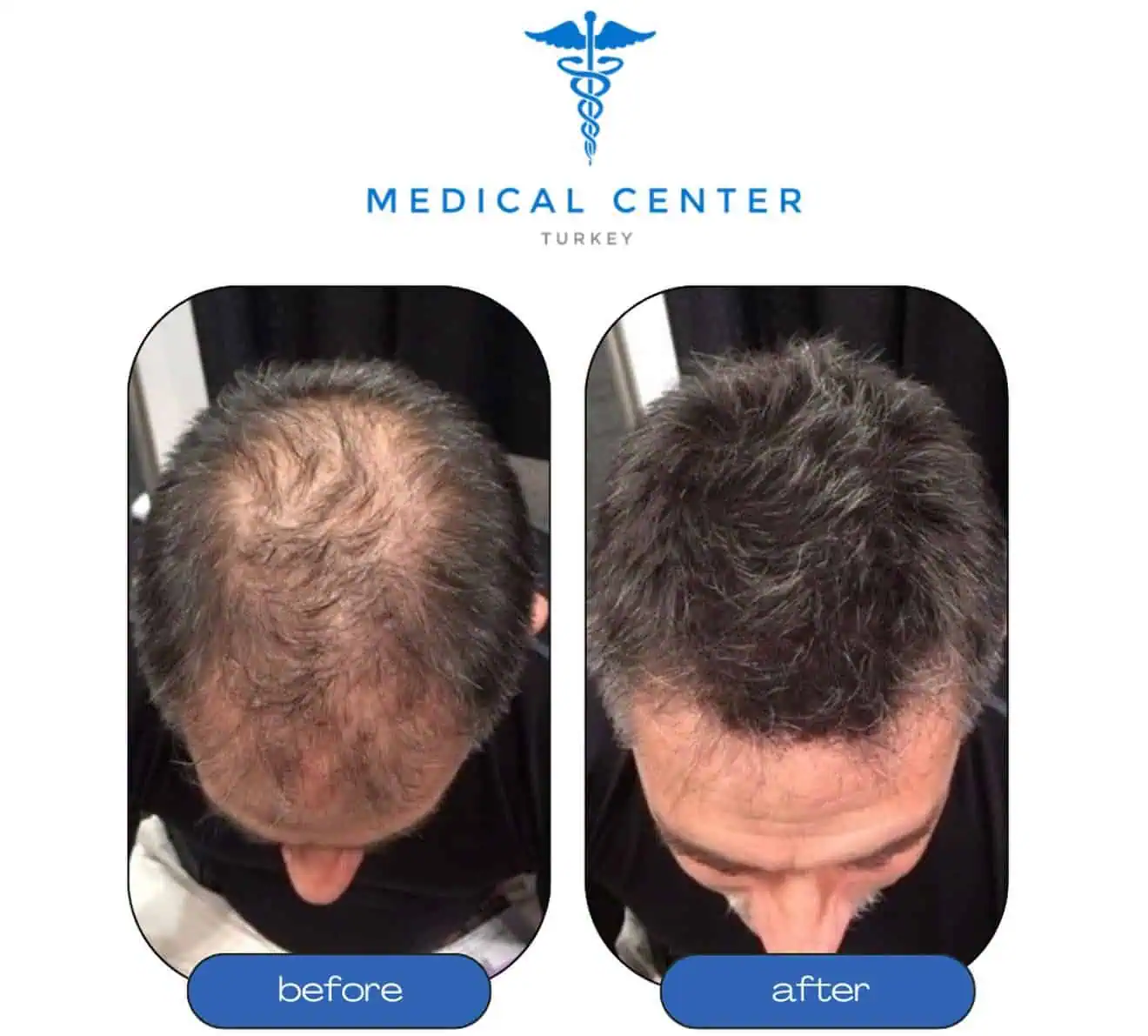 Hair transplant before and after result 6