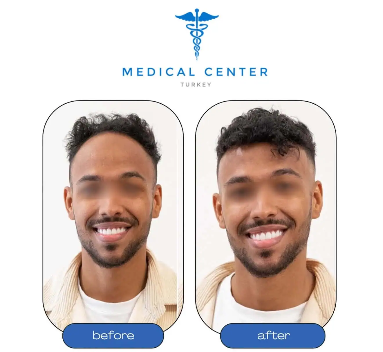 Hair transplant before and after result 8