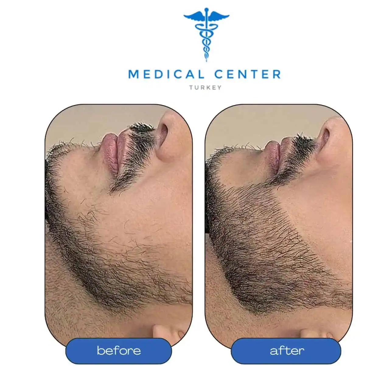 Hair transplant before and after result 9