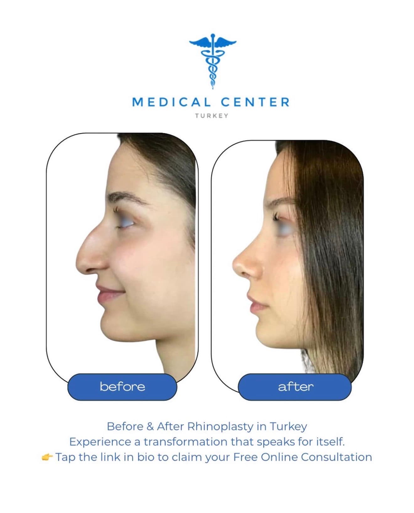 Rhinoplasty before and after result 1 — Medical Center Turkey patient
