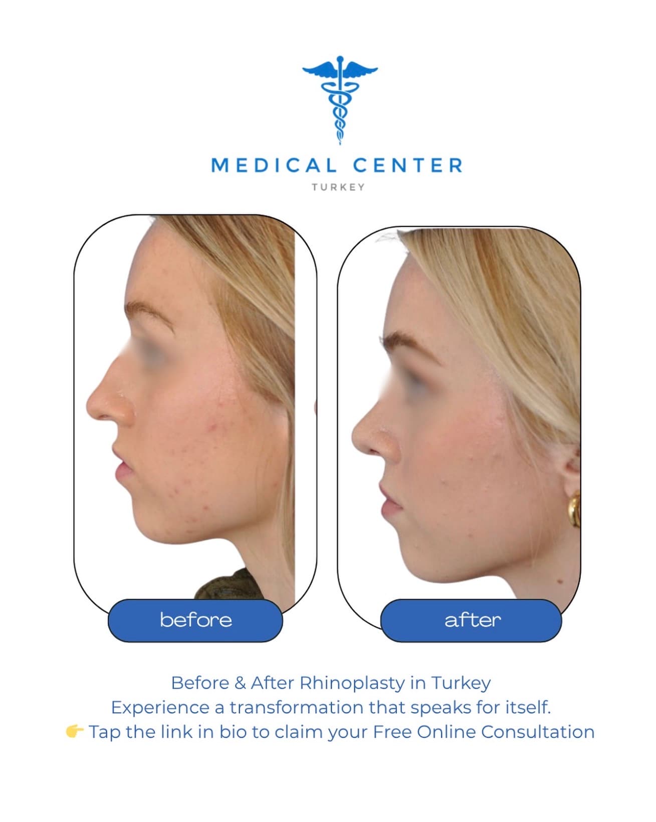 Rhinoplasty before and after result 2 — Medical Center Turkey patient