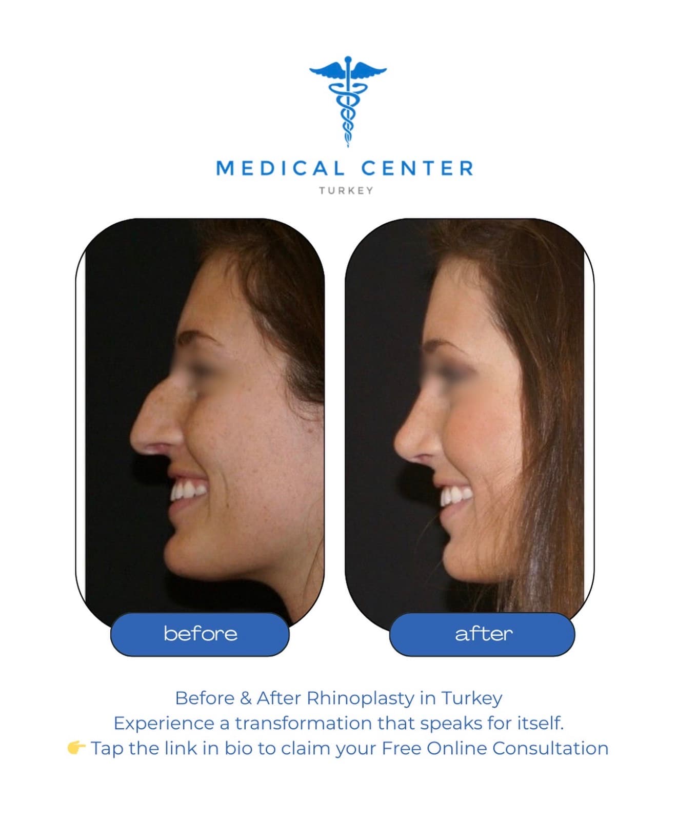Rhinoplasty before and after result 3 — Medical Center Turkey patient