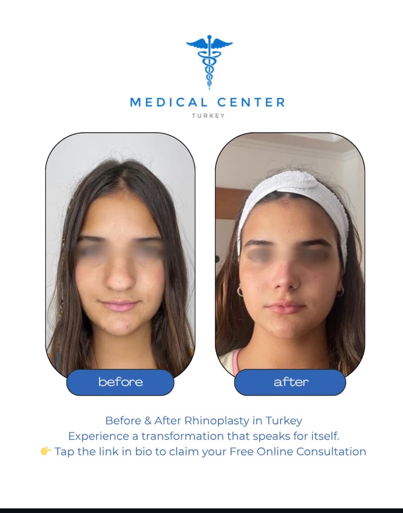 Rhinoplasty before and after result 4 — Medical Center Turkey patient